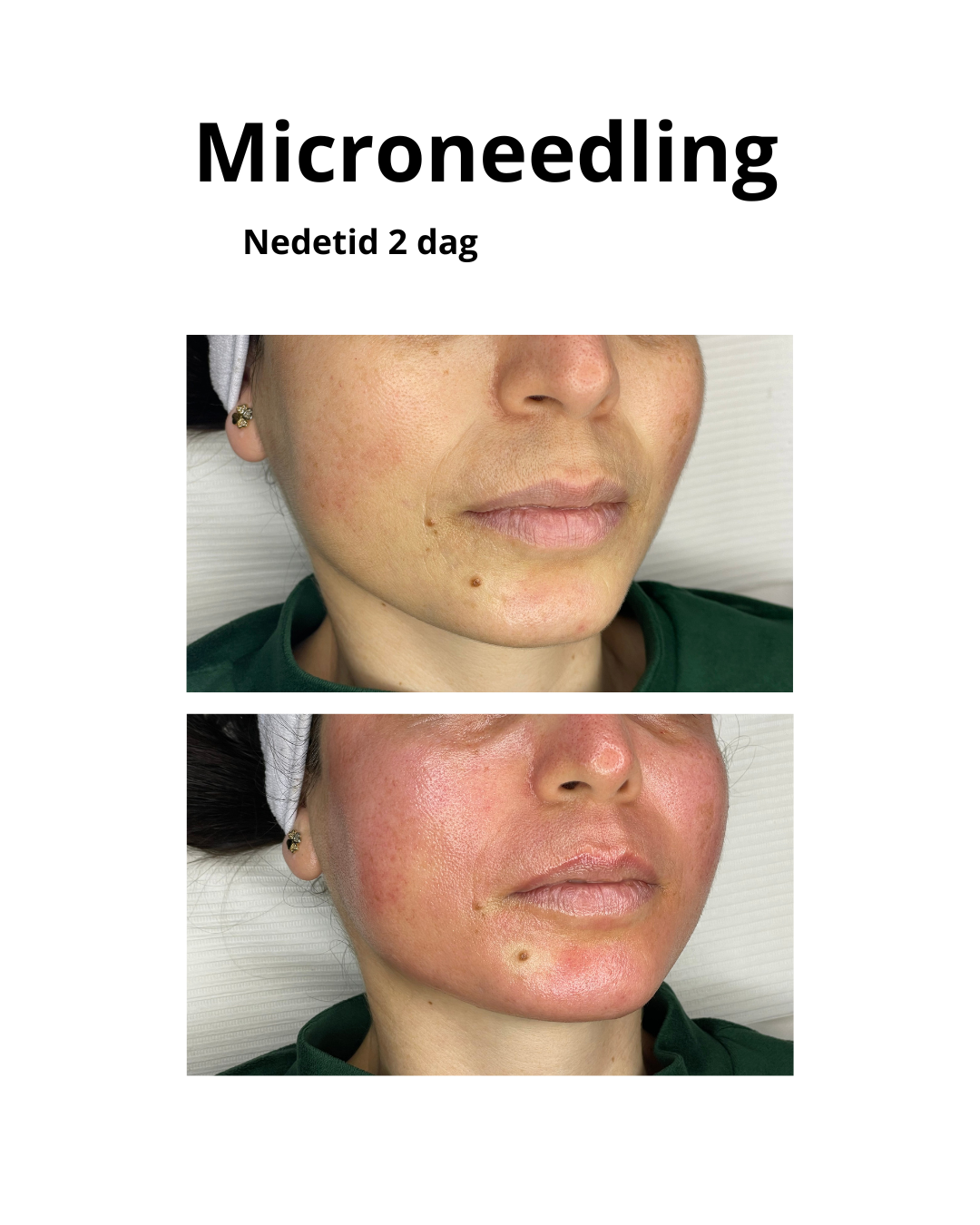 microneedling i aarhus hudforyngende antiage behandling peptider